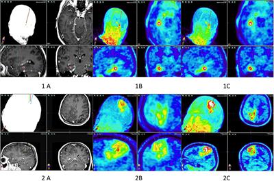 Glioma Biopsy Based on Hybrid Dual Time-Point FET-PET/MRI—A Proof of Concept Study